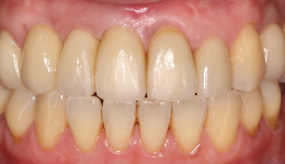 After Implant Crowns	